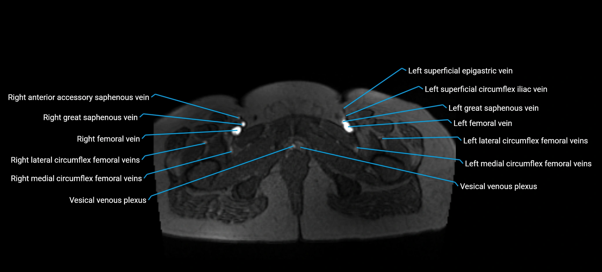 MRV abdomen pelvis & lower limb axial cross sectional anatomy labelled MRI image 196 (1).webp